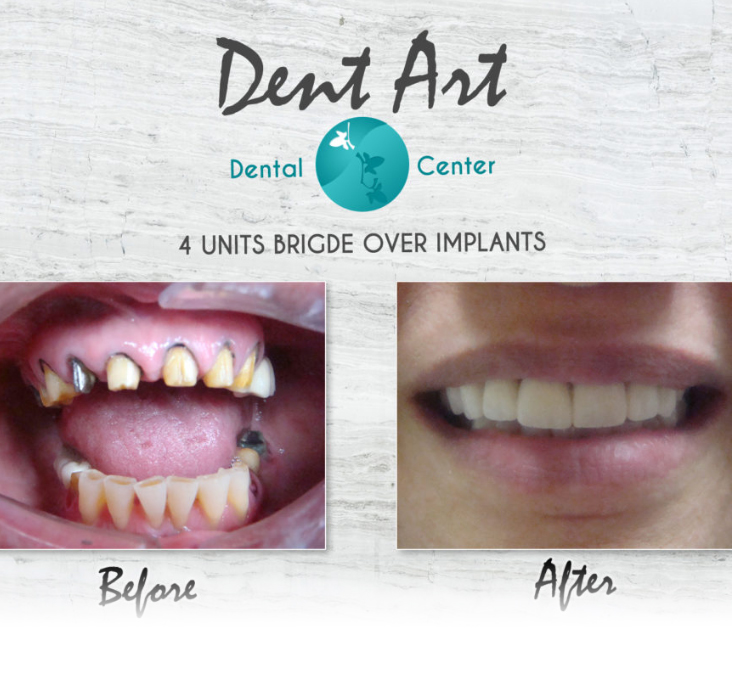 before-after-dental-crowns3