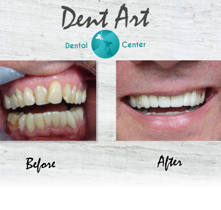 before-after-dental-crowns7