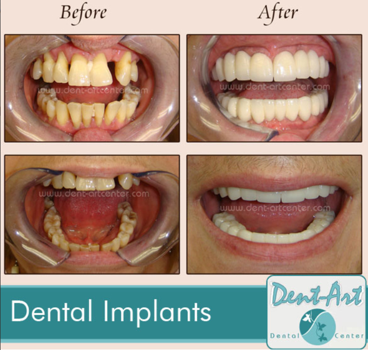 before-after-dentalimplants