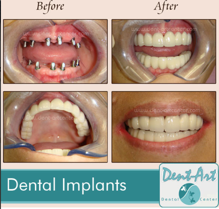 before-after-dentalimplants6