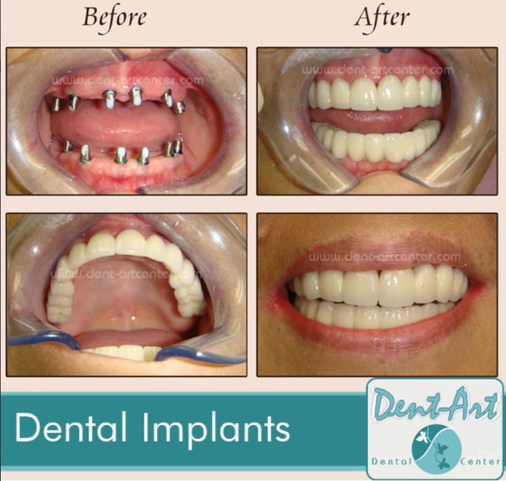 before-after-dentalimplants9
