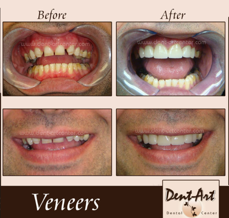 before-after-porcelain-veneers10