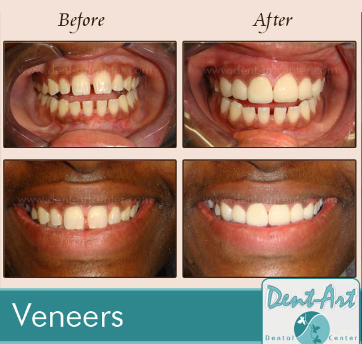 before-after-porcelain-veneers12