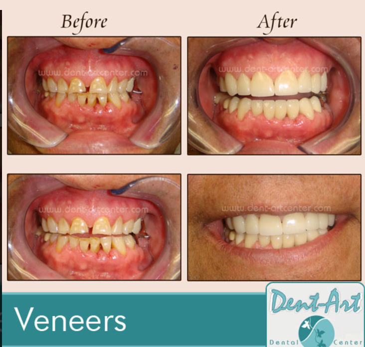 before-after-porcelain-veneers9